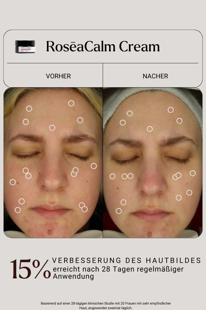 RoseCalm Cream - vorher bild nachher bild