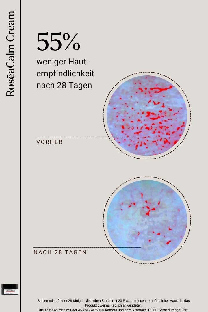 RoseCalm Cream - weniger Empfindlichkeit