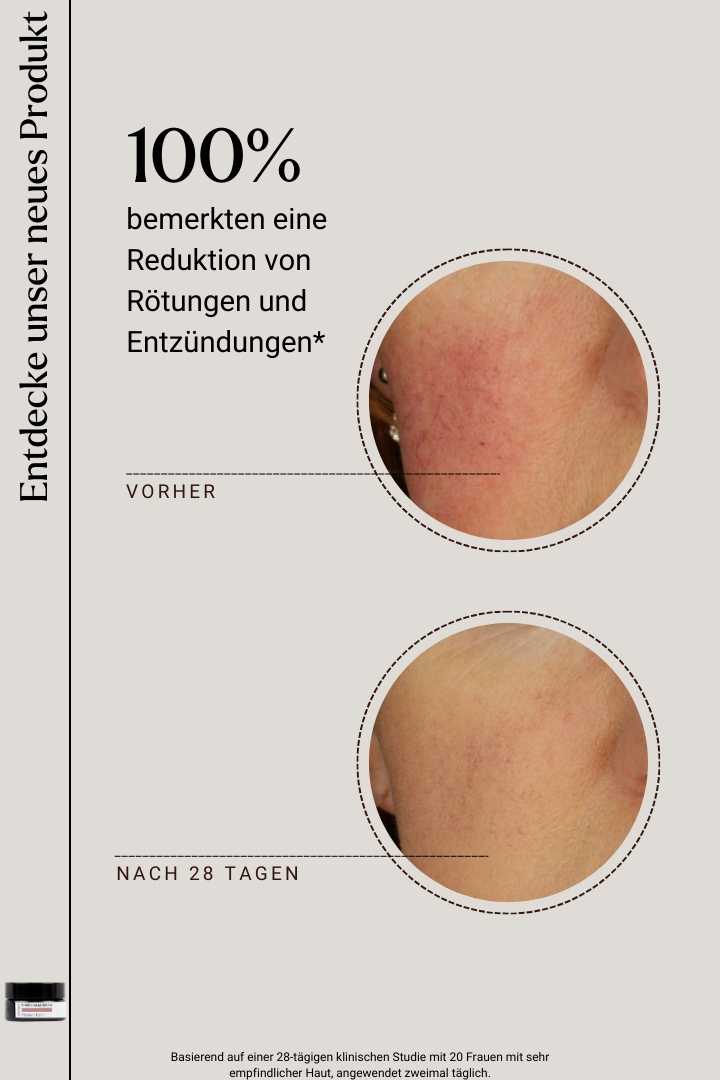RoseCalm Cream - vorher nachher
