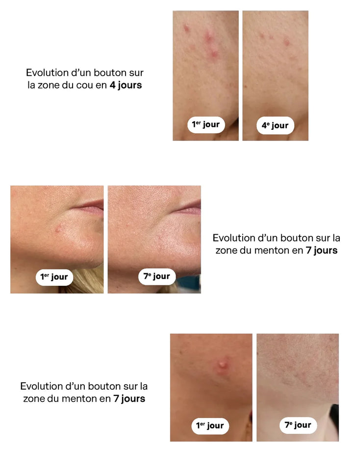 Anwendungsbilder des La Canopée Soin Ciblé Perfection Roll-on bei unreiner Haut