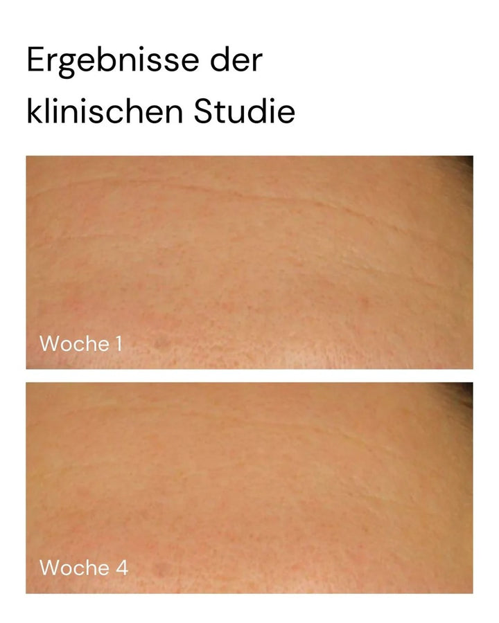 Klinische Studienergebnisse zum MERME Berlin Super Stable C Face Serum mit sichtbar ebenmäßigerem Hautbild - Vorher und Nachher
