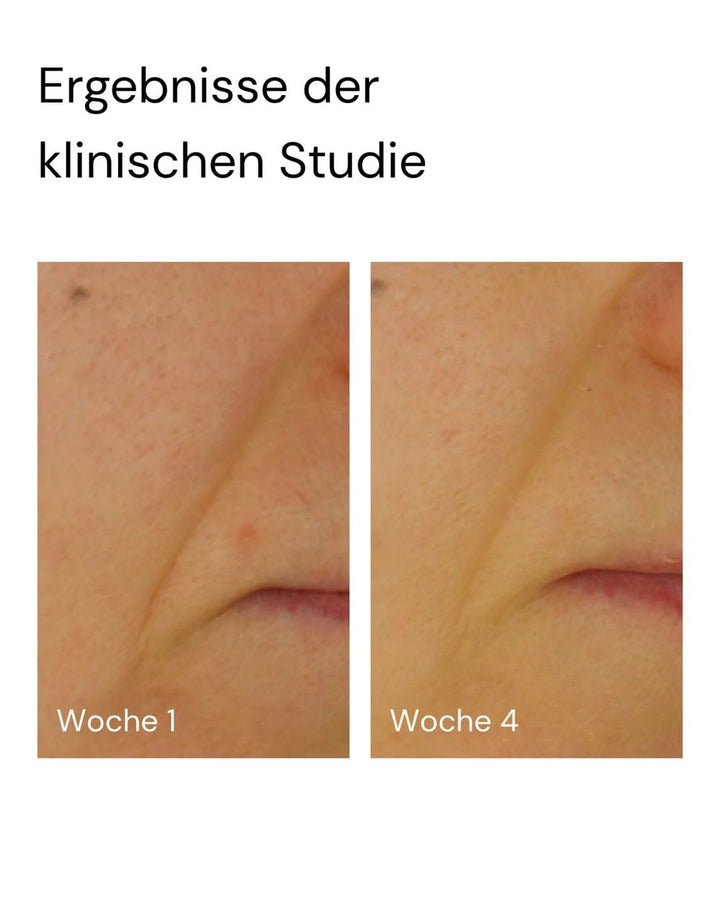 Vorher-nachher Vergleich der klinischen Studie zum MERME Berlin Super Stable C Face Serum