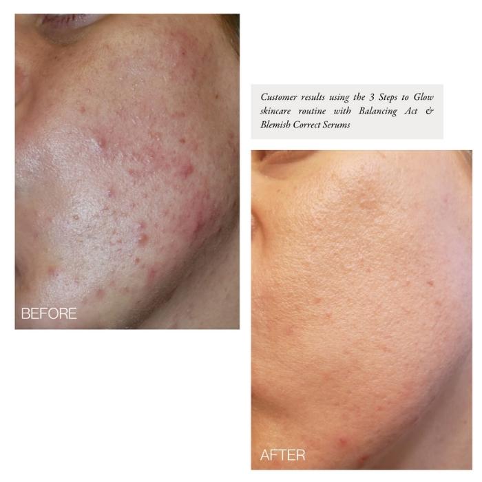 Formule Intensif No. 5 Blemish Correct Before and After