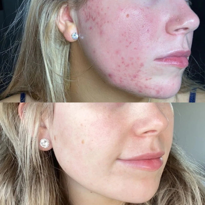 Serum of Clear 30 ml - before - after